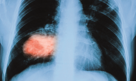 Carcinoma al polmone