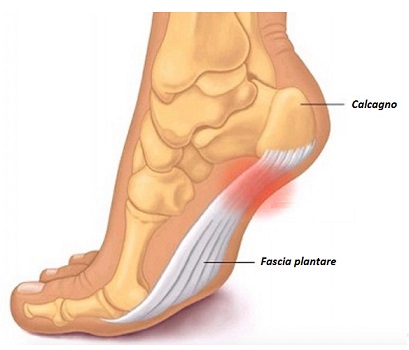 Fascite_plantare