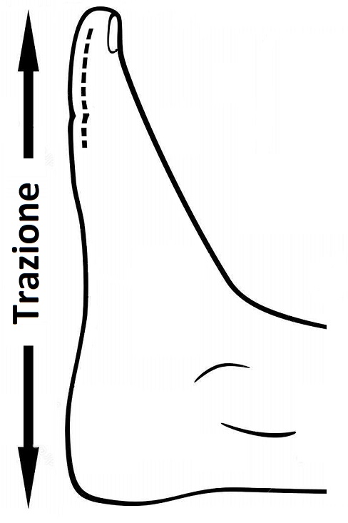 Artrosi cervicale