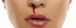 Sangue dal naso