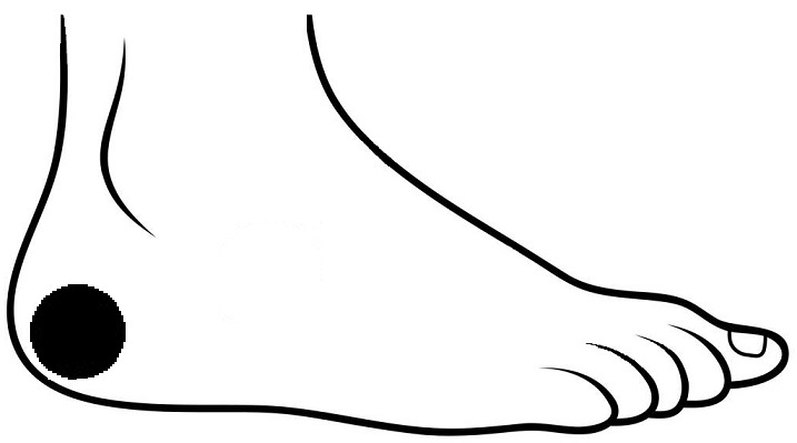 Sciatalgia