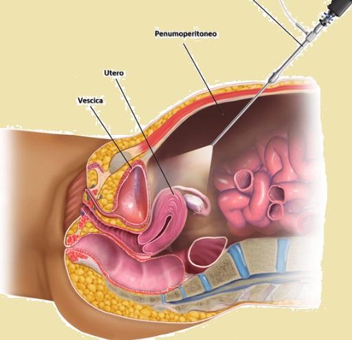Chirurgia endometriosi