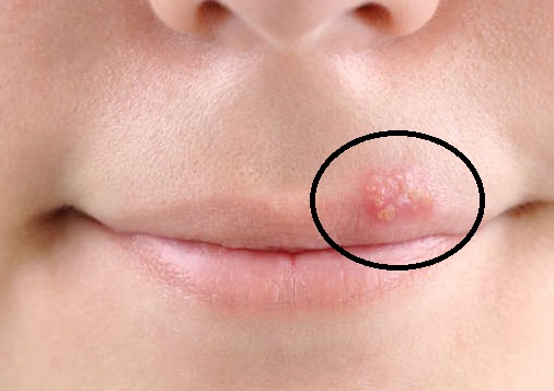 herpes-labiale 1