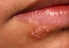 hlabial1