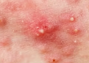 Acne 1