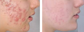 Acne nodulo-cistica miglioramento