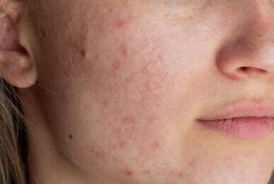 Acne