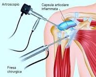 Artroscopia
