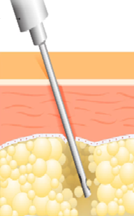 Liposuzione