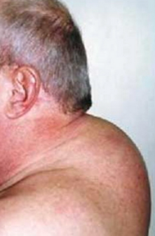 Sindrome di Cushing
