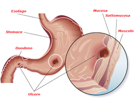 Ulcere gastriche