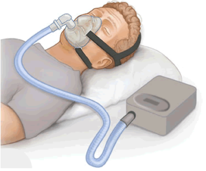 CPAP