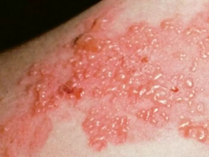 Herpes Zoster Vescicole
