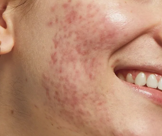 Herpes Zoster Viso