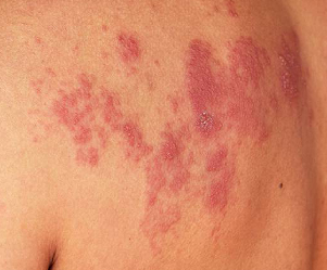 Herpes Zoster foto 02