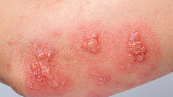 Herpes Zoster foto 03