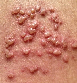 Herpes Zoster foto 04