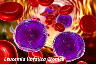 Leucemia linfatica cronica