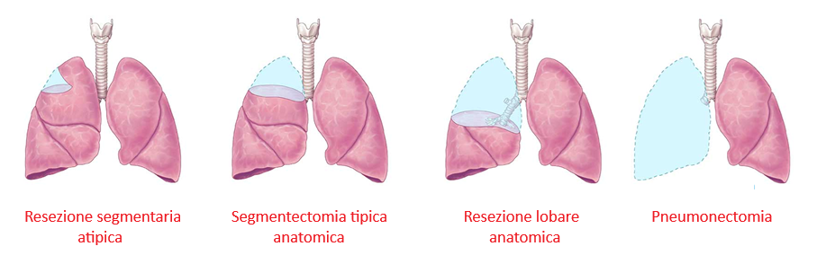 Sezioni del polmone
