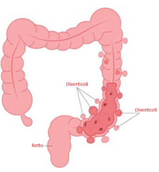 Diverticoli