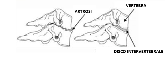Artrosi intervertebrale