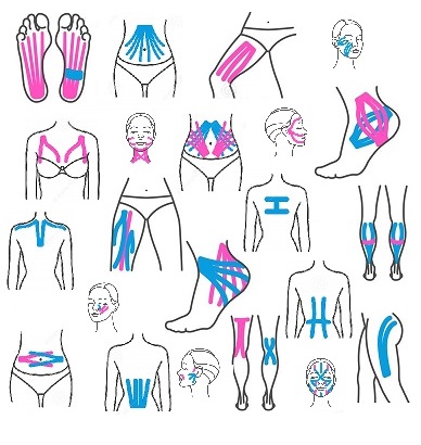 Kinesio Taping