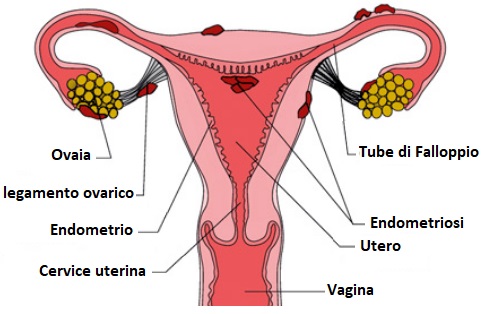 Endometriosi