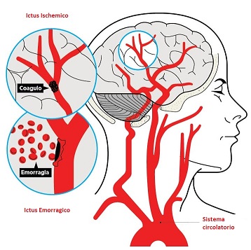 ICTUS
