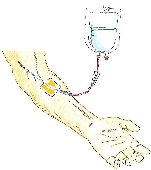 chemioterapia